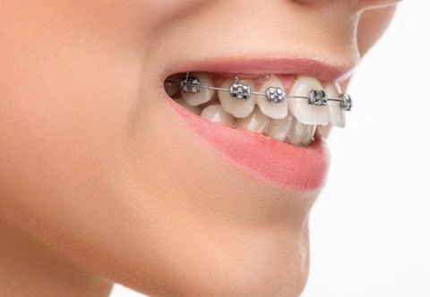 Niềng răng hô là gì? Niềng bao lâu? Chi phí bao nhiêu